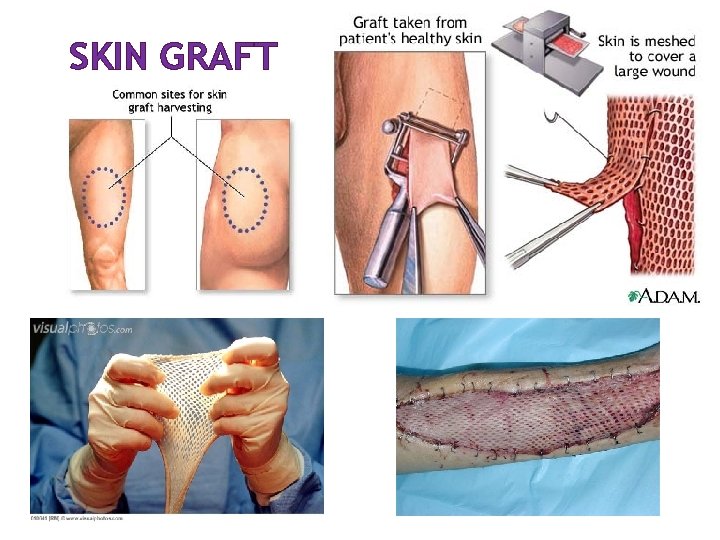 SKIN GRAFT 