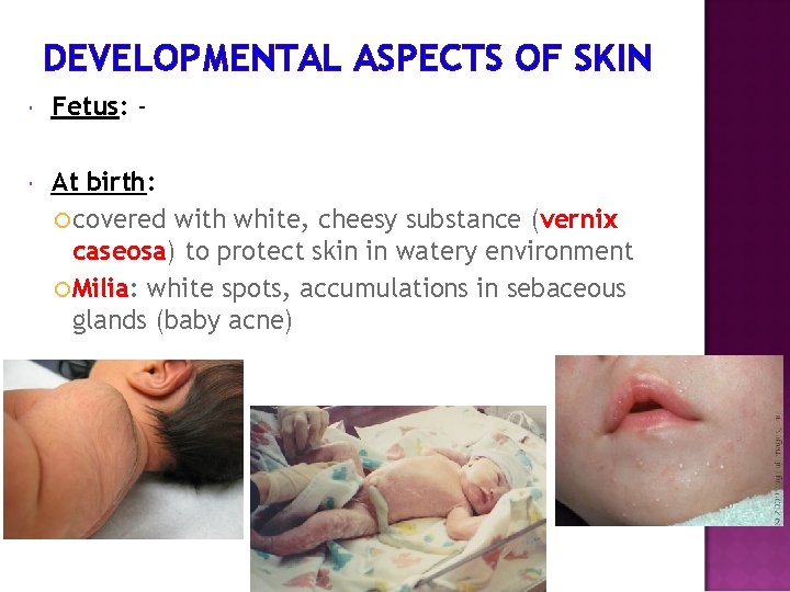 DEVELOPMENTAL ASPECTS OF SKIN Fetus: - At birth: covered with white, cheesy substance (vernix