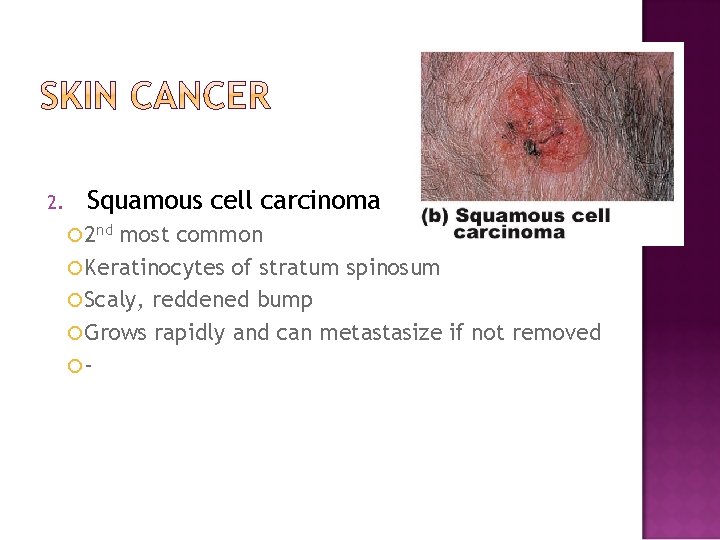 2. Squamous cell carcinoma 2 nd most common Keratinocytes of stratum spinosum Scaly, reddened