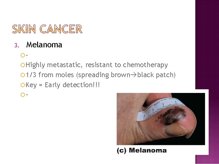 3. Melanoma Highly metastatic, resistant to chemotherapy 1/3 from moles (spreading brown black patch)
