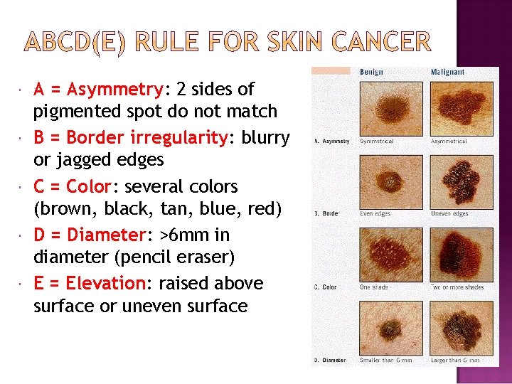  A = Asymmetry: 2 sides of pigmented spot do not match B =