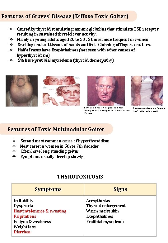 Features of Graves' Disease (Diffuse Toxic Goiter) ❖ Caused by thyroid stimulating immunoglobulins that