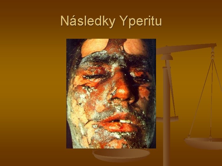 Následky Yperitu 