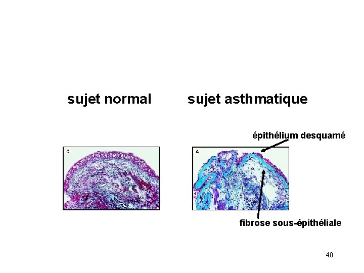 sujet normal sujet asthmatique épithélium desquamé fibrose sous-épithéliale 40 