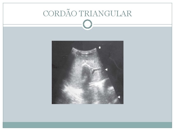 CORDÃO TRIANGULAR 