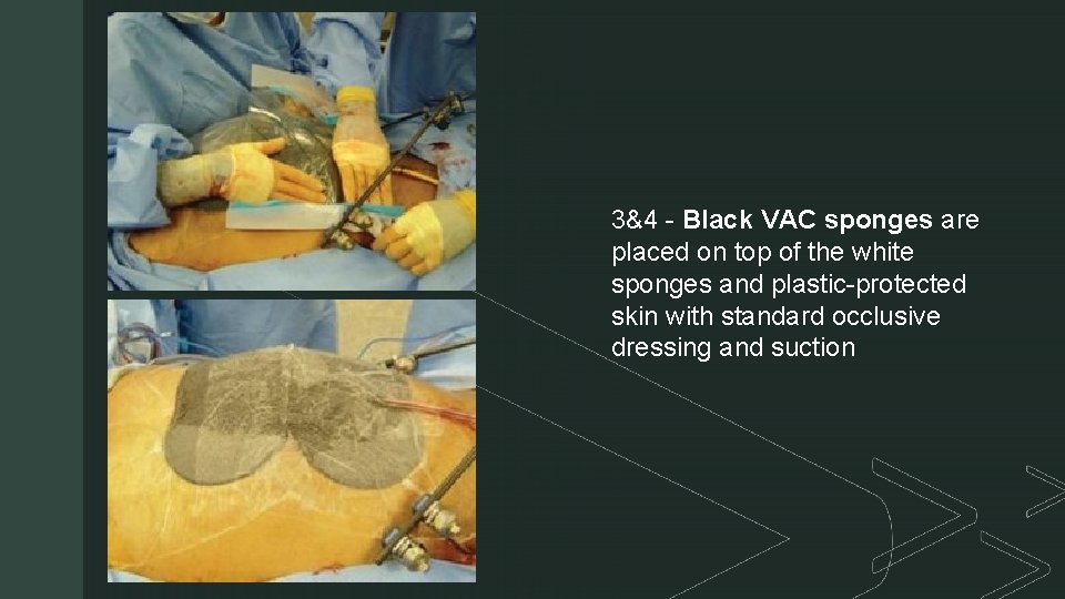 z 3&4 - Black VAC sponges are placed on top of the white sponges