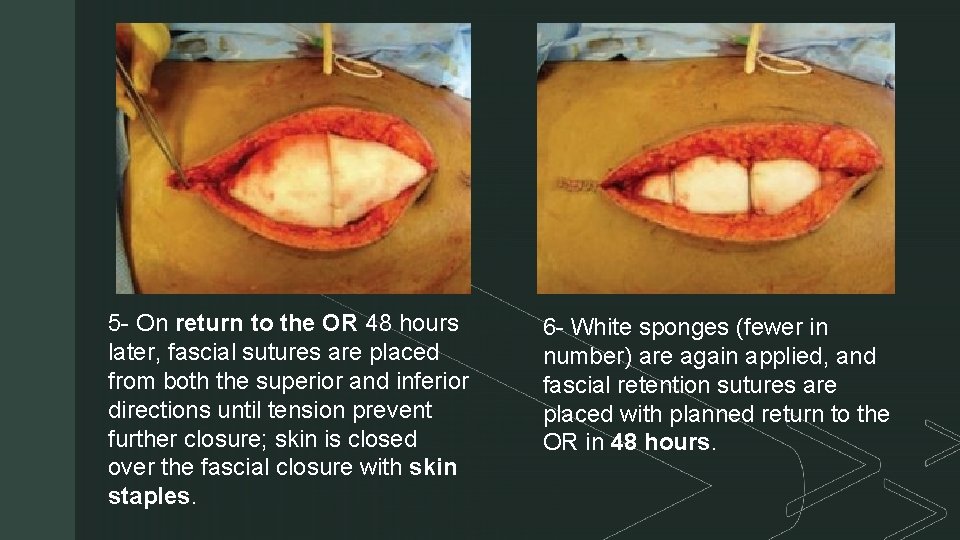 z 5 - On return to the OR 48 hours later, fascial sutures are