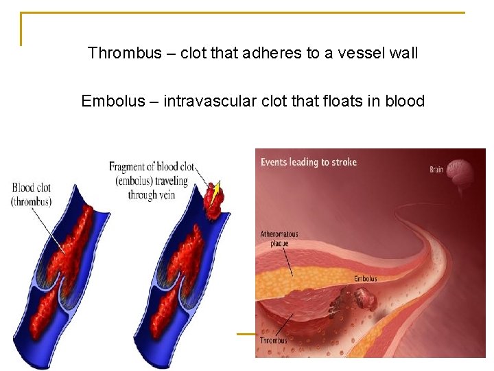 Thrombus – clot that adheres to a vessel wall Embolus – intravascular clot that