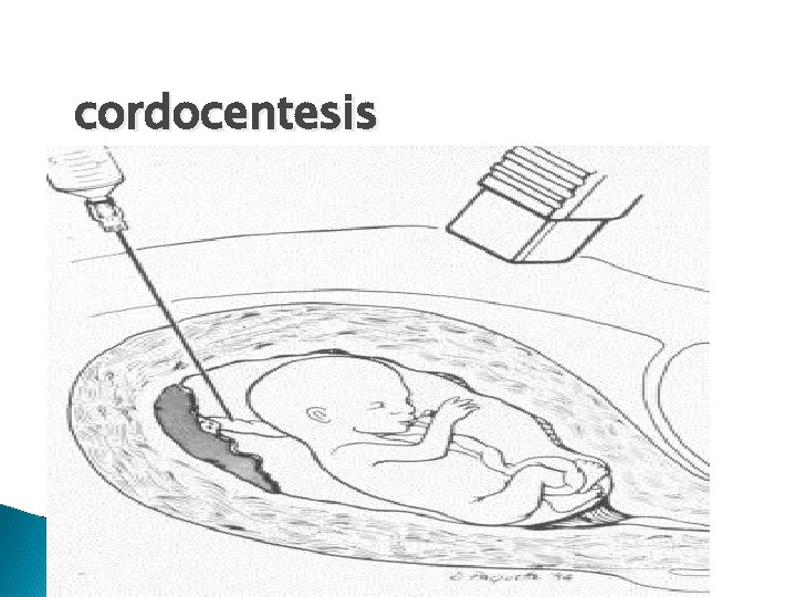 cordocentesis 