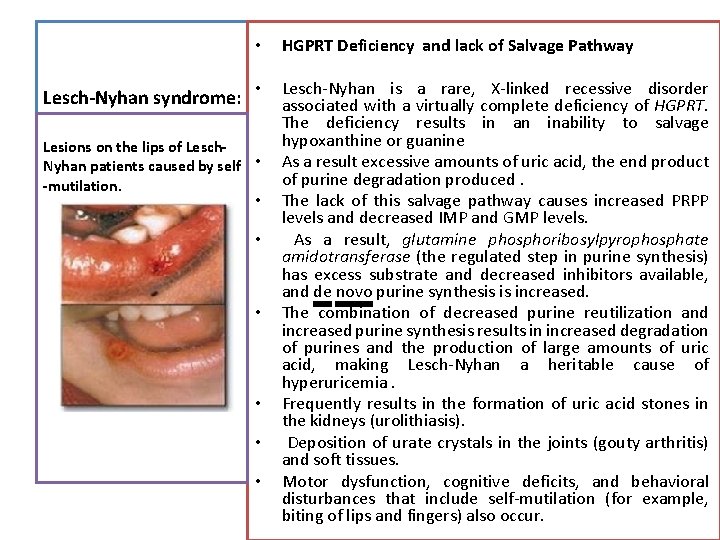 Lesch-Nyhan syndrome: • HGPRT Deficiency and lack of Salvage Pathway • Lesch-Nyhan is a