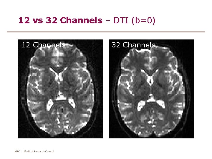 12 vs 32 Channels – DTI (b=0) 12 Channels 32 Channels 