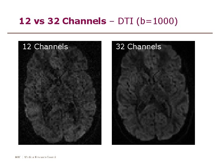 12 vs 32 Channels – DTI (b=1000) 12 Channels 32 Channels 