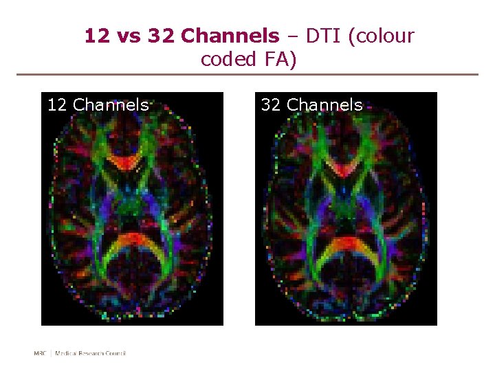 12 vs 32 Channels – DTI (colour coded FA) 12 Channels 32 Channels 