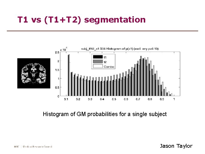 T 1 vs (T 1+T 2) segmentation Histogram of GM probabilities for a single