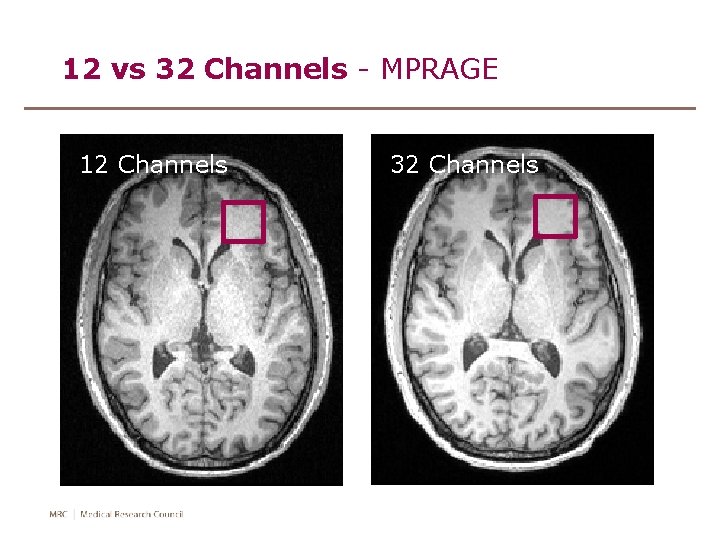12 vs 32 Channels - MPRAGE 12 Channels 32 Channels 