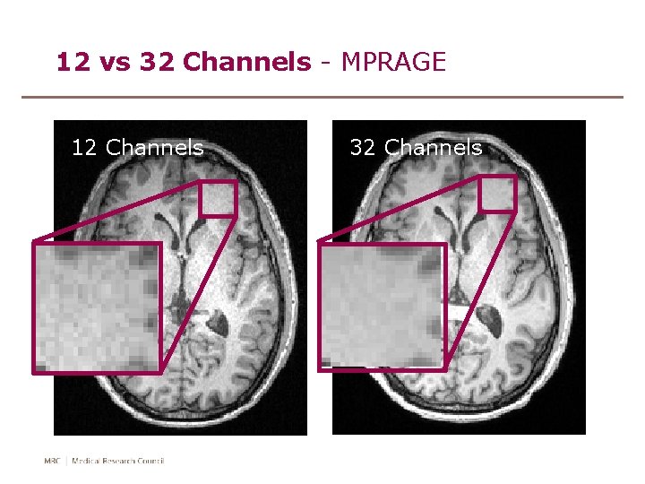 12 vs 32 Channels - MPRAGE 12 Channels 32 Channels 