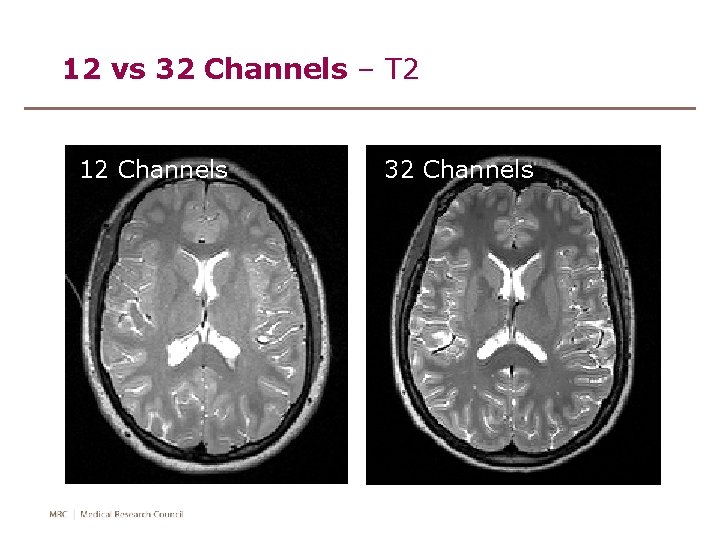 12 vs 32 Channels – T 2 12 Channels 32 Channels 