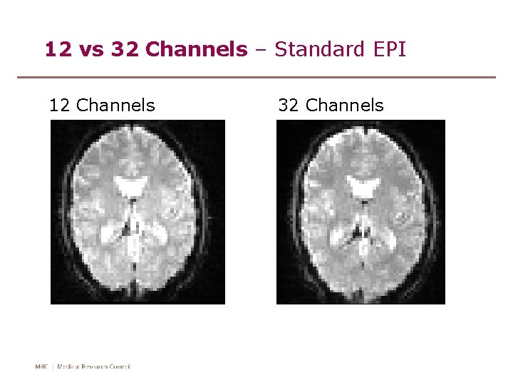 12 vs 32 Channels – Standard EPI 12 Channels 32 Channels 