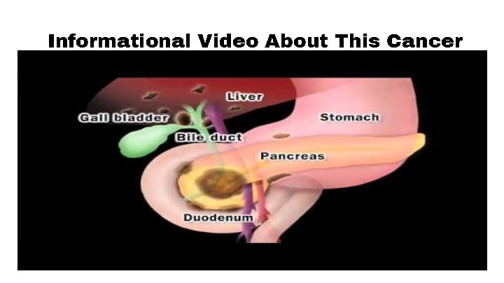 Informational Video About This Cancer 