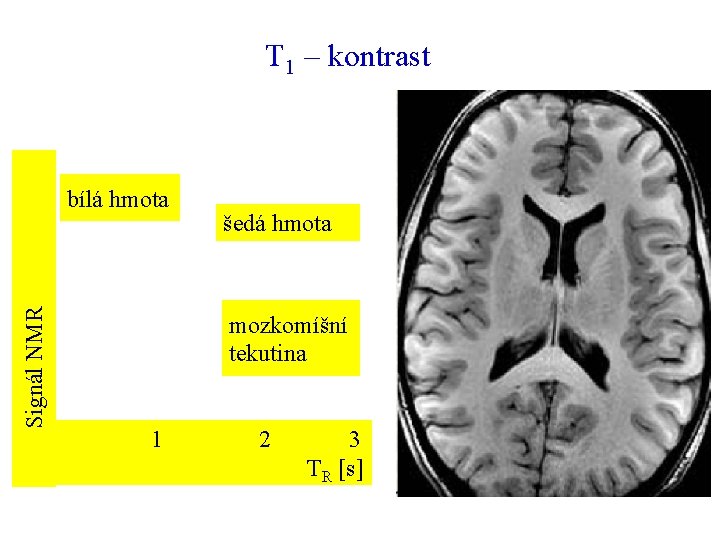 T 1 – kontrast Signál NMR bílá hmota šedá hmota mozkomíšní tekutina 1 2