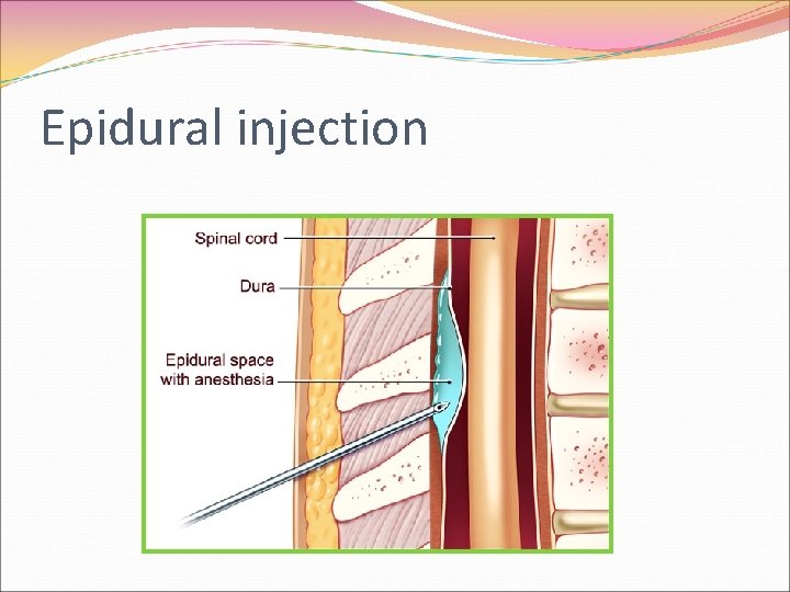 Epidural injection 