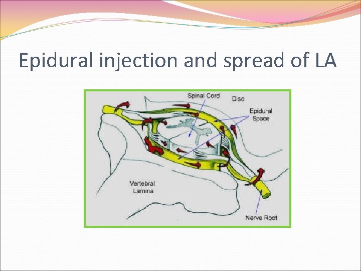 Epidural injection and spread of LA 