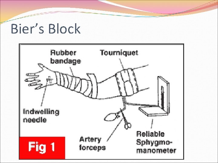 Bier’s Block 