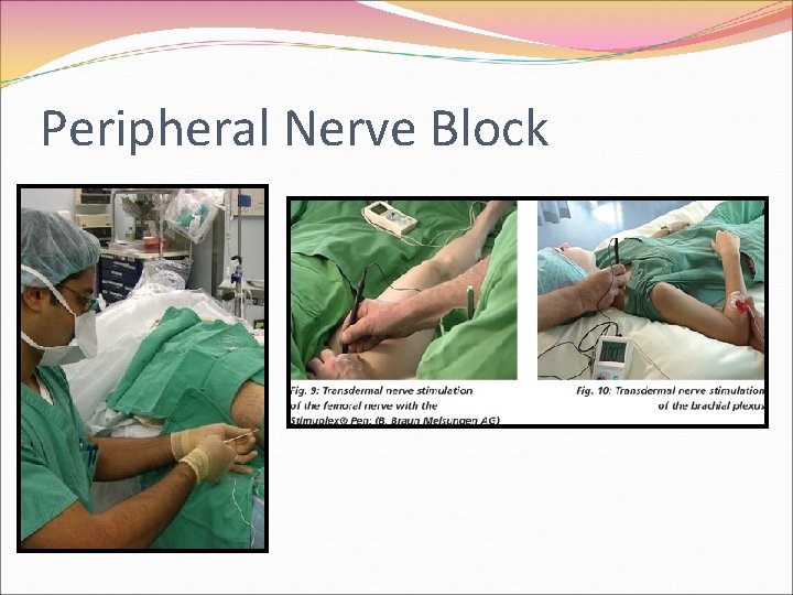 Peripheral Nerve Block 