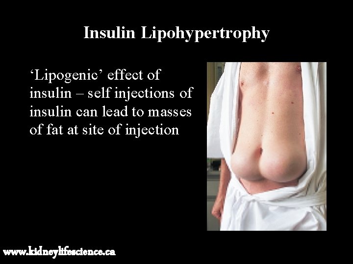 Insulin Lipohypertrophy ‘Lipogenic’ effect of insulin – self injections of insulin can lead to