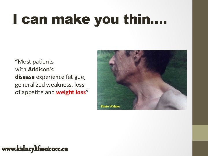 I can make you thin…. “Most patients with Addison's disease experience fatigue, generalized weakness,