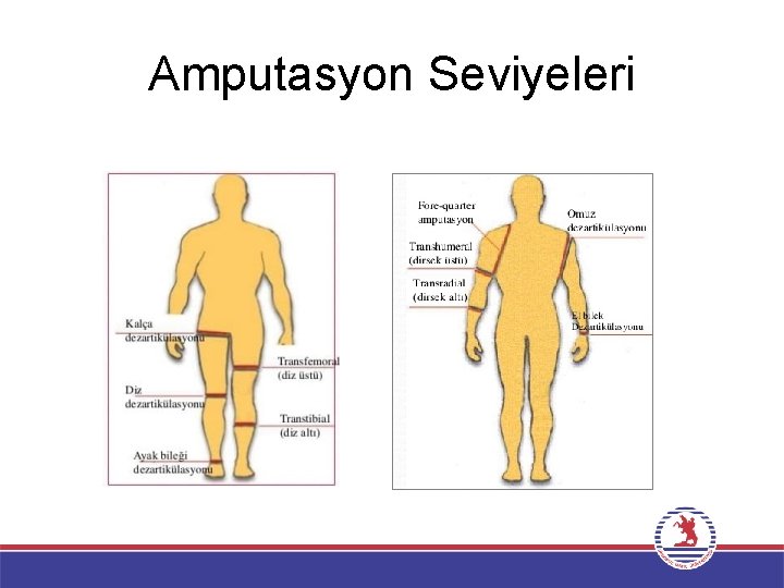 Amputasyon Seviyeleri 