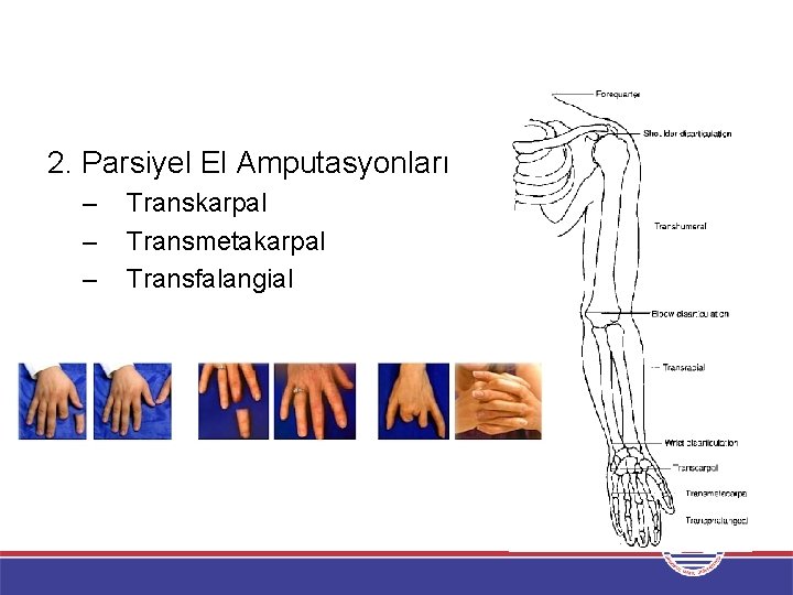 2. Parsiyel El Amputasyonları – – – Transkarpal Transmetakarpal Transfalangial 