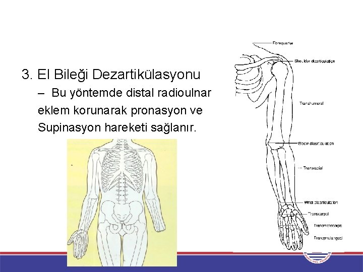 3. El Bileği Dezartikülasyonu – Bu yöntemde distal radioulnar eklem korunarak pronasyon ve Supinasyon