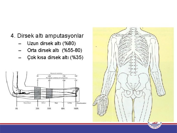 4. Dirsek altı amputasyonlar – – – Uzun dirsek altı (%80) Orta dirsek altı