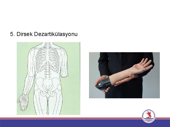 5. Dirsek Dezartikülasyonu 