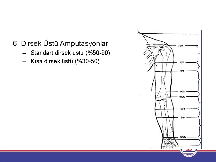 6. Dirsek Üstü Amputasyonlar – Standart dirsek üstü (%50 -90) – Kısa dirsek üstü