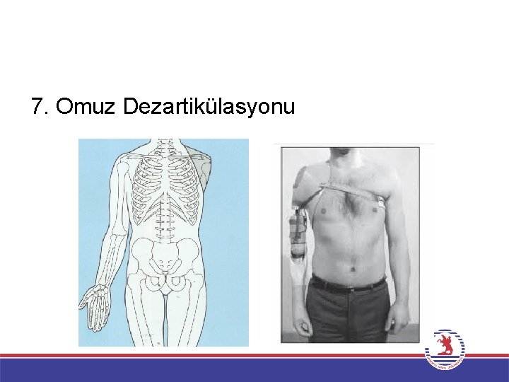 7. Omuz Dezartikülasyonu 