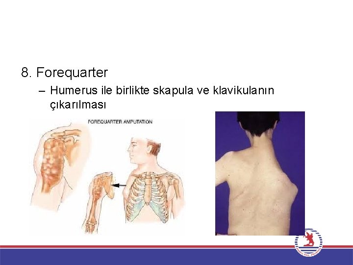 8. Forequarter – Humerus ile birlikte skapula ve klavikulanın çıkarılması 