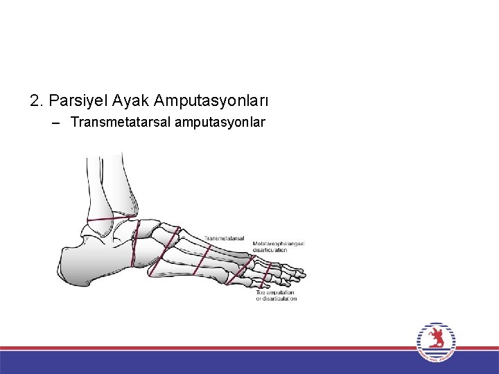 2. Parsiyel Ayak Amputasyonları – Transmetatarsal amputasyonlar 