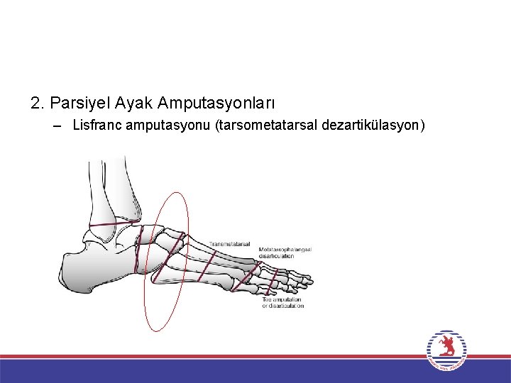 2. Parsiyel Ayak Amputasyonları – Lisfranc amputasyonu (tarsometatarsal dezartikülasyon) 