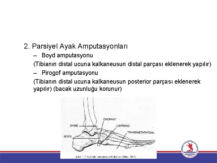 2. Parsiyel Ayak Amputasyonları – Boyd amputasyonu (Tibianın distal ucuna kalkaneusun distal parçası eklenerek