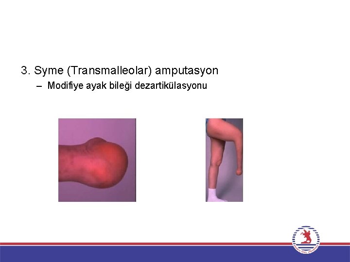 3. Syme (Transmalleolar) amputasyon – Modifiye ayak bileği dezartikülasyonu 