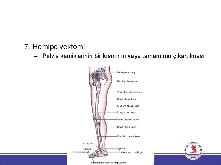 7. Hemipelvektomi – Pelvis kemiklerinin bir kısmının veya tamamının çıkartılması 