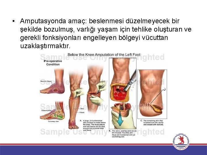  • Amputasyonda amaç: beslenmesi düzelmeyecek bir şekilde bozulmuş, varlığı yaşam için tehlike oluşturan