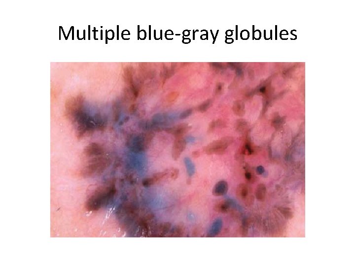 Multiple blue-gray globules 