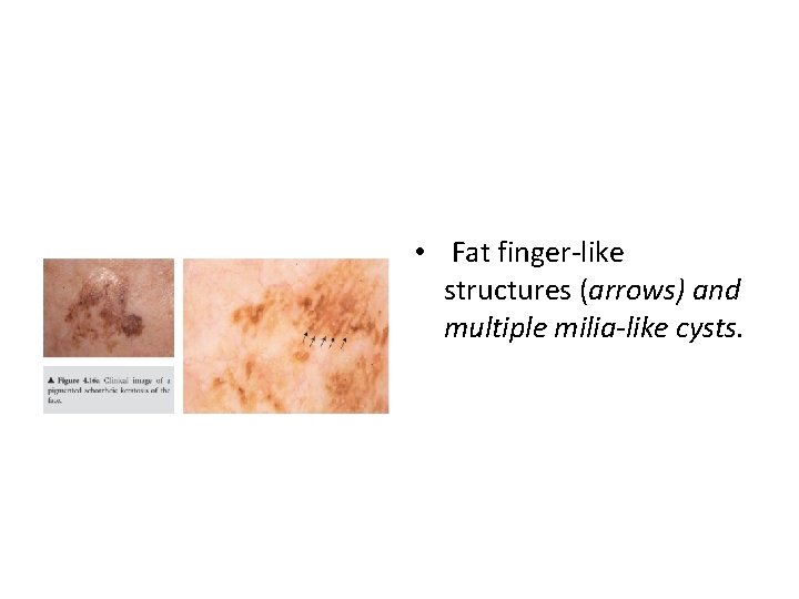  • Fat finger-like structures (arrows) and multiple milia-like cysts. 
