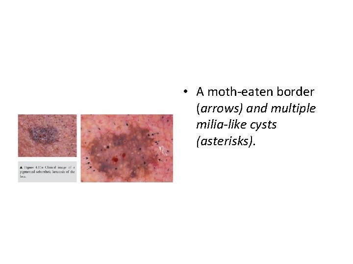 • A moth-eaten border (arrows) and multiple milia-like cysts (asterisks). 