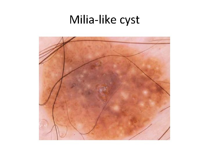 Milia-like cyst 