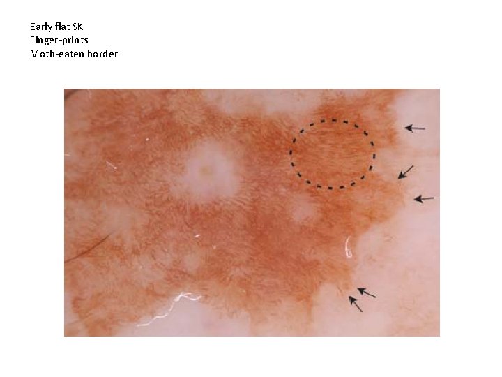 Early flat SK Finger-prints Moth-eaten border 