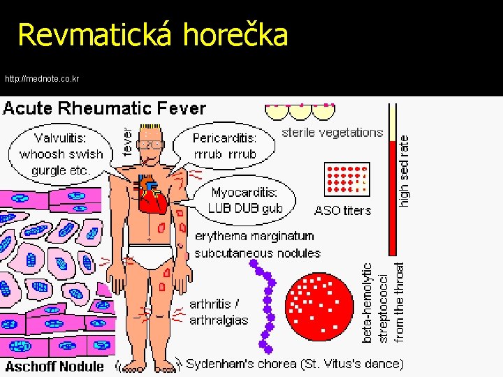 Revmatická horečka http: //mednote. co. kr 